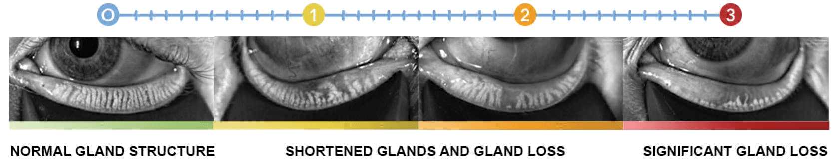 chart showing normal meibomian gland structure through significant gland loss